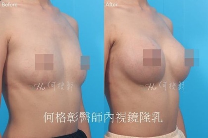 內視鏡隆乳-16