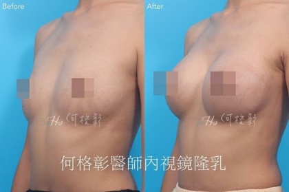 內視鏡隆乳-17