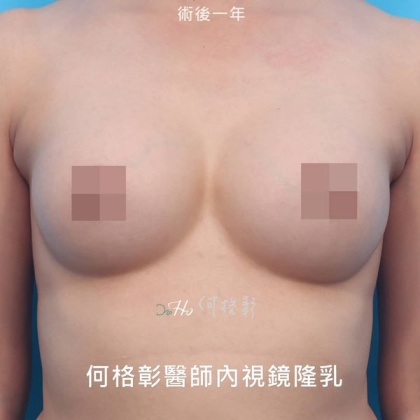 內視鏡隆乳-19