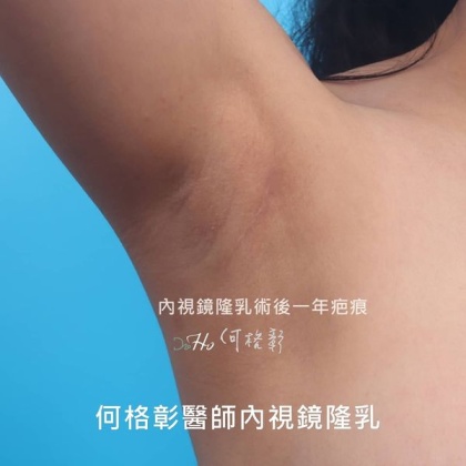內視鏡隆乳-20