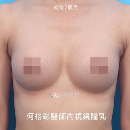 內視鏡隆乳-21