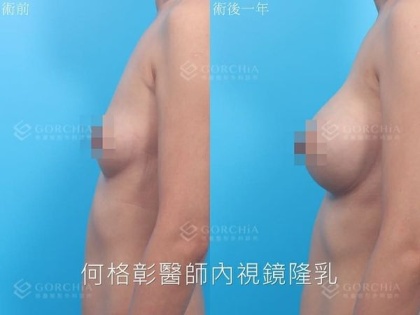內視鏡隆乳-25