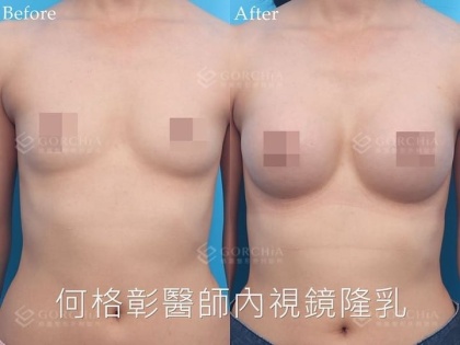 內視鏡隆乳-26