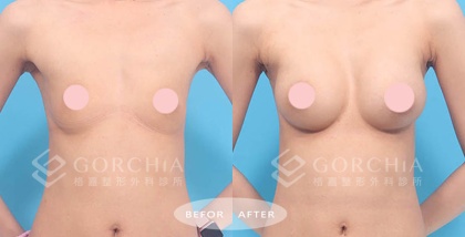 內視鏡隆乳-27