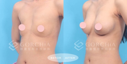 內視鏡隆乳-29