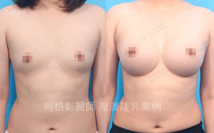 內視鏡隆乳-30