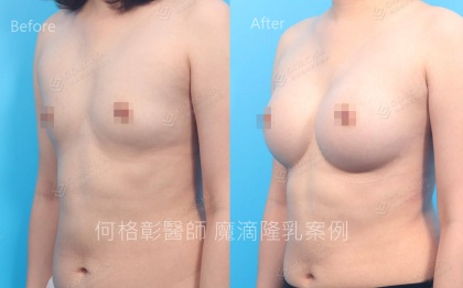 內視鏡隆乳-31
