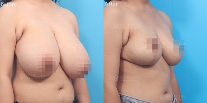縮乳手術-6