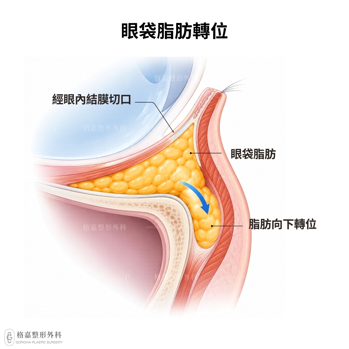 眼袋脂肪回填與脂肪轉位示意圖