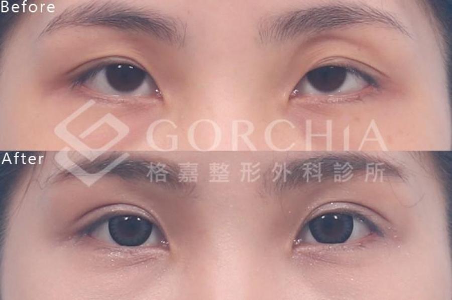 縫合式提眼肌手術案例 -格嘉整形外科診所