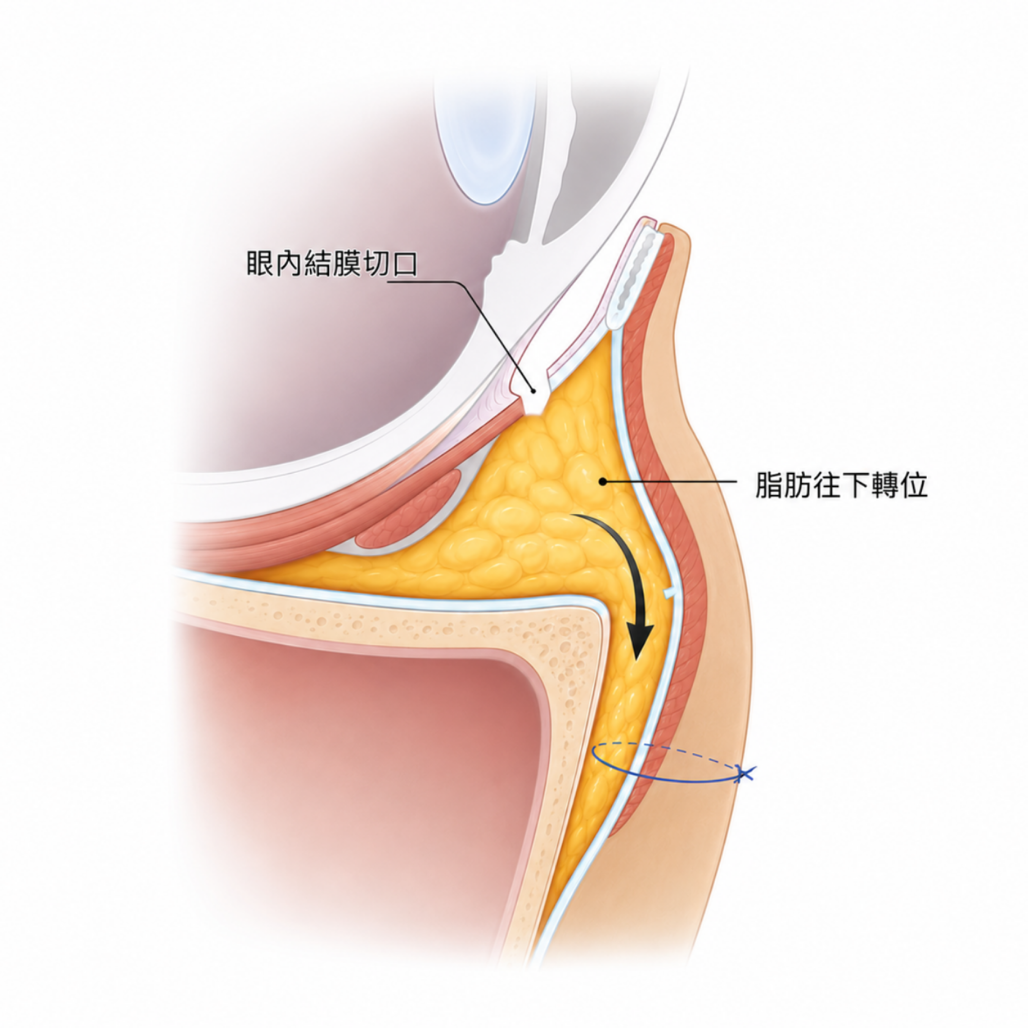 左右眼睜眼力量差異示意(版型測試圖)