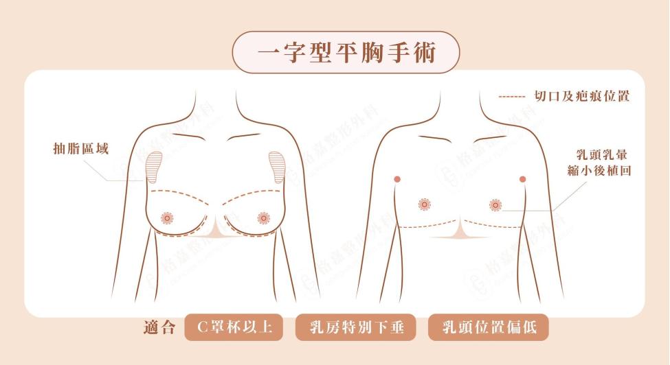 一字型平胸手術乳腺皮膚切除與乳頭乳暈重新定位示意