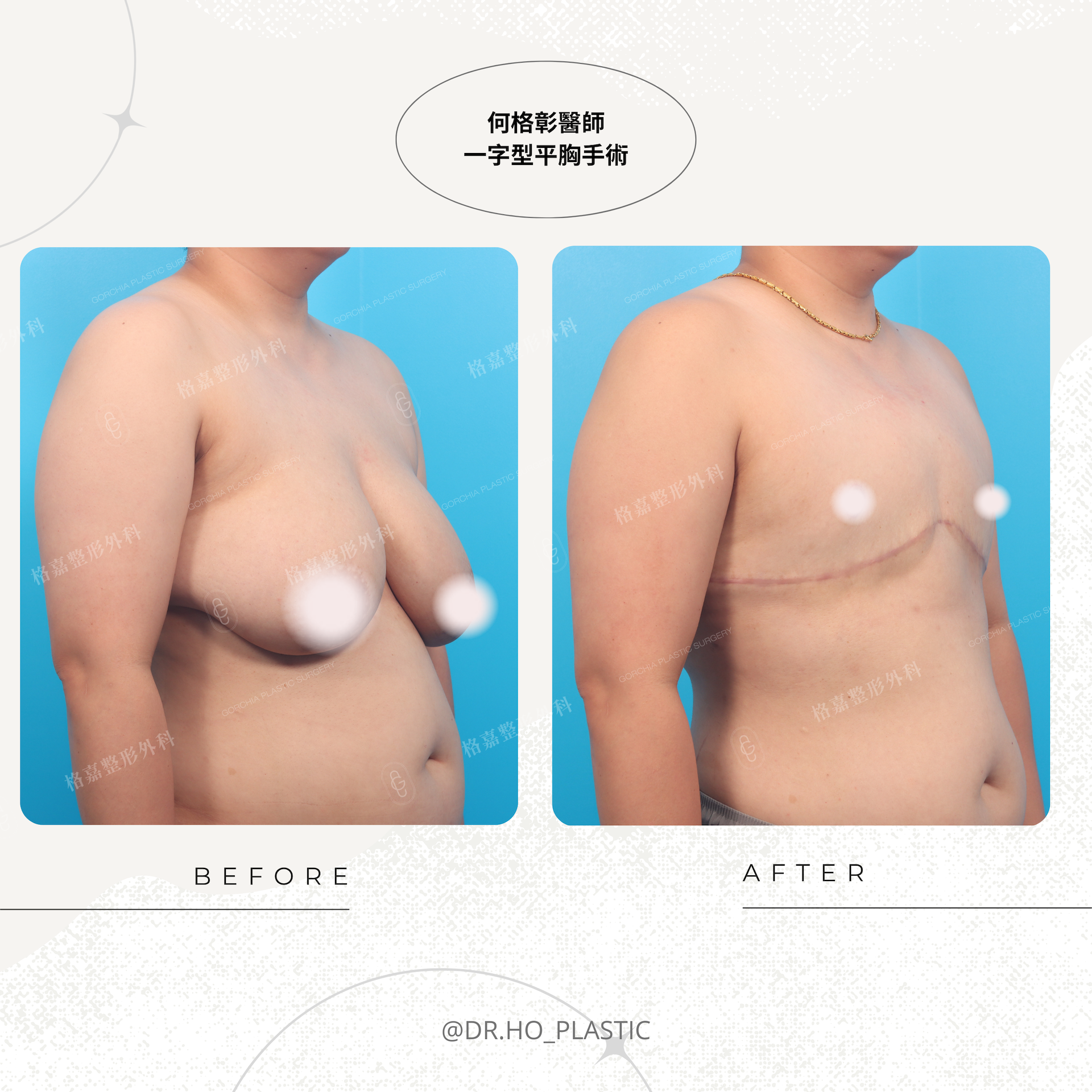 一字型平胸側胸副乳與腋下胸廓塑形範圍