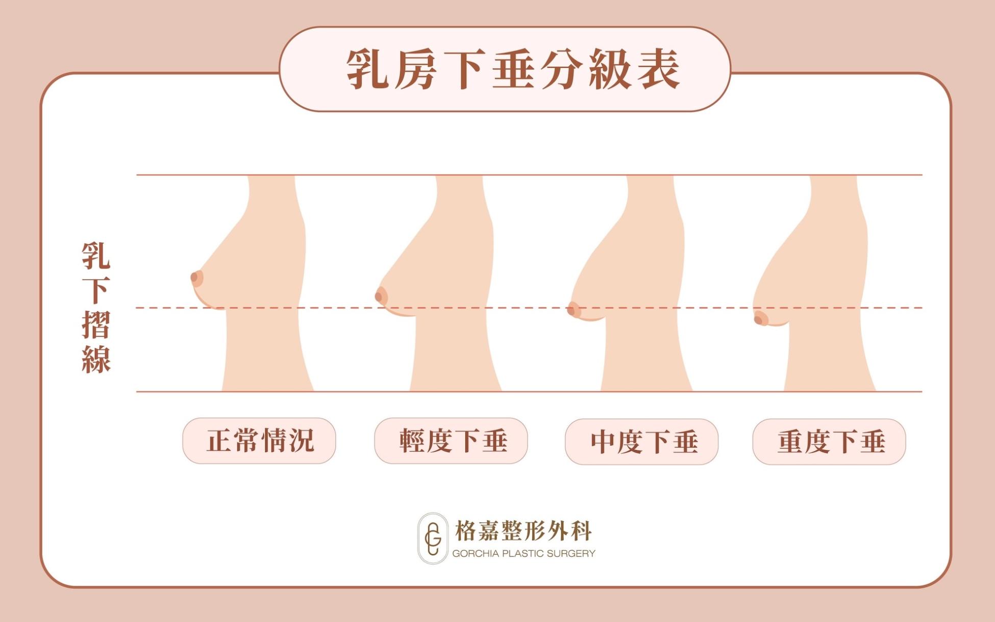 乳房下垂分級無明顯下垂假性下垂Grade I Grade II Grade III示意