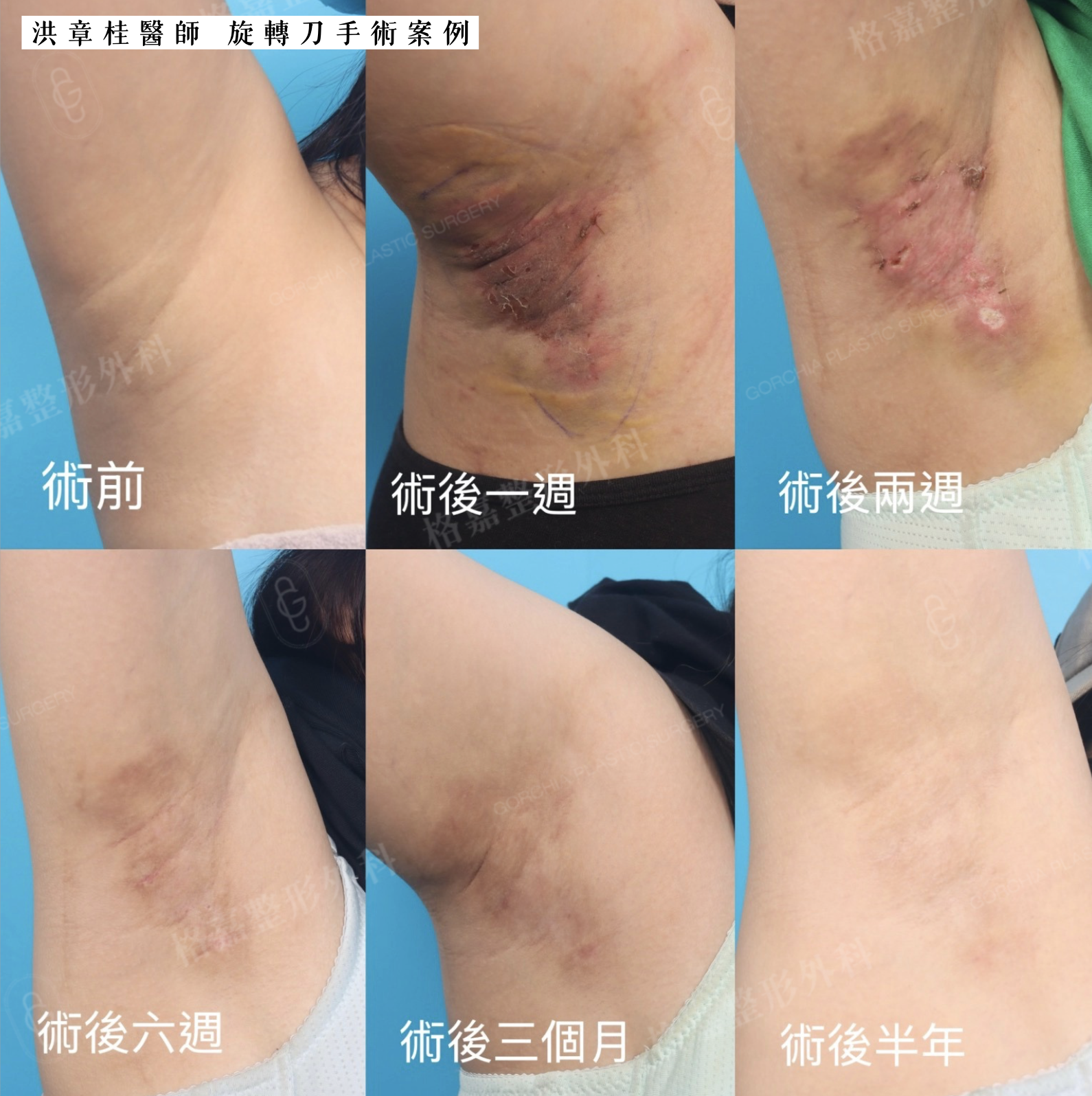 狐臭手術腋毛與頂漿腺處理範圍術前設計