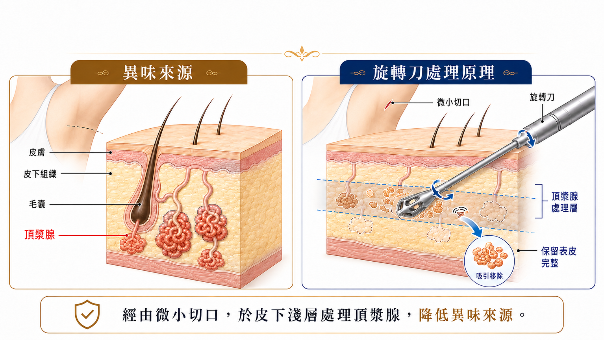 旋轉刀狐臭手術頂漿腺與皮下刮除示意