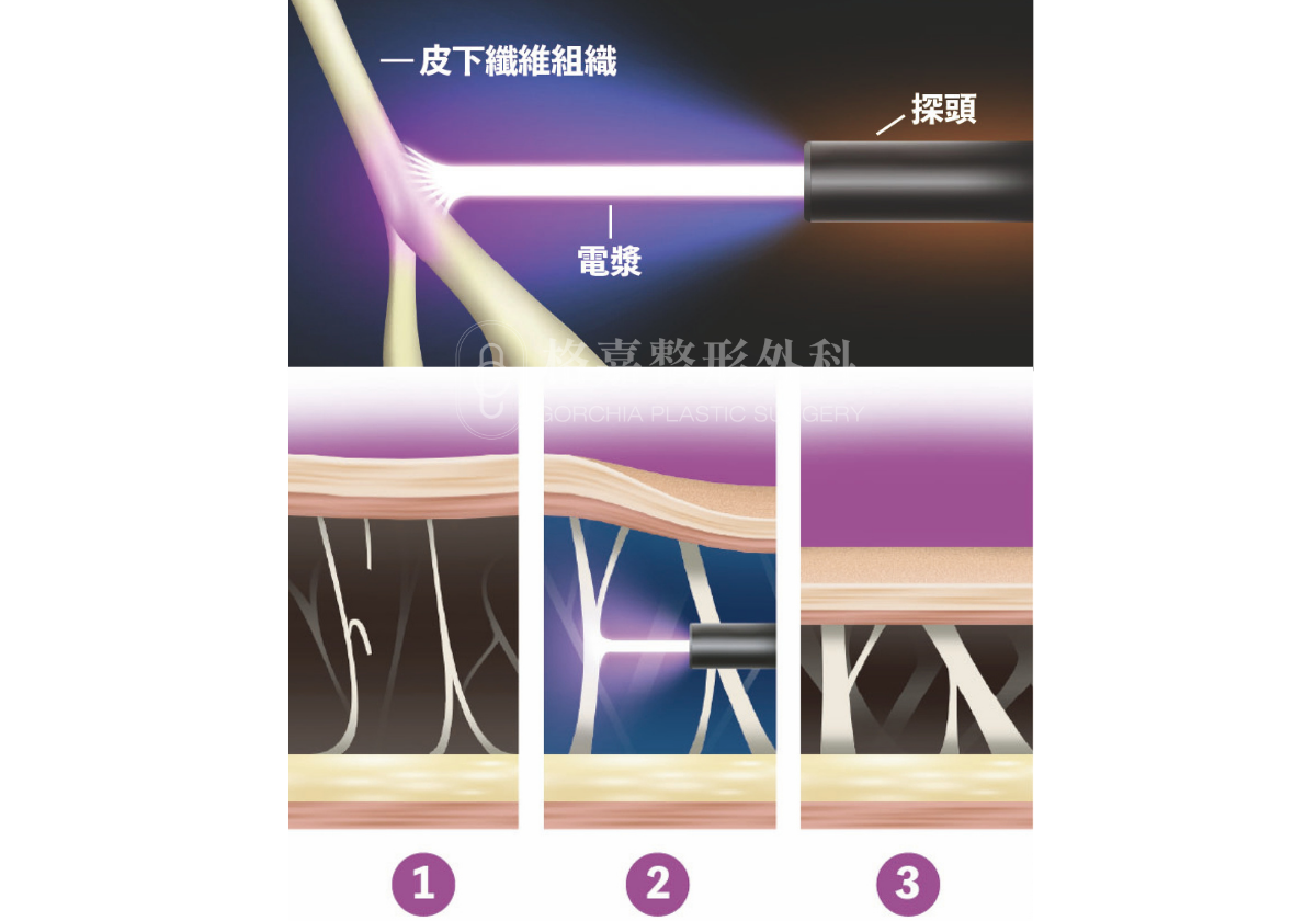超能電漿作用原理