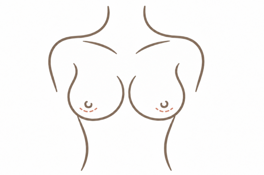 乳暈隆乳切口位置示意