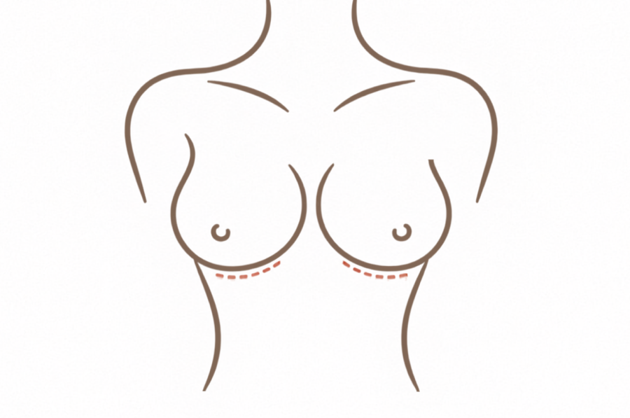 乳房下緣隆乳切口位置示意