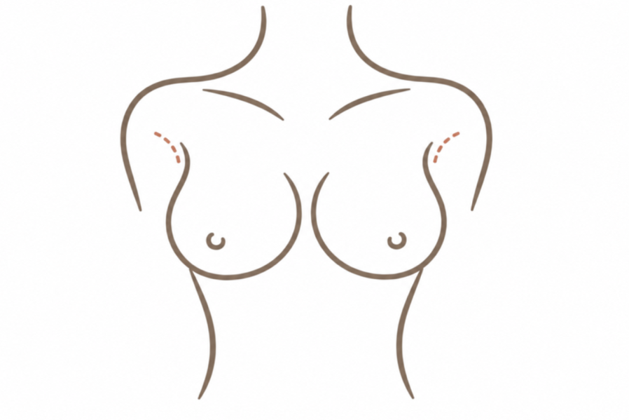 腋下隆乳切口位置示意