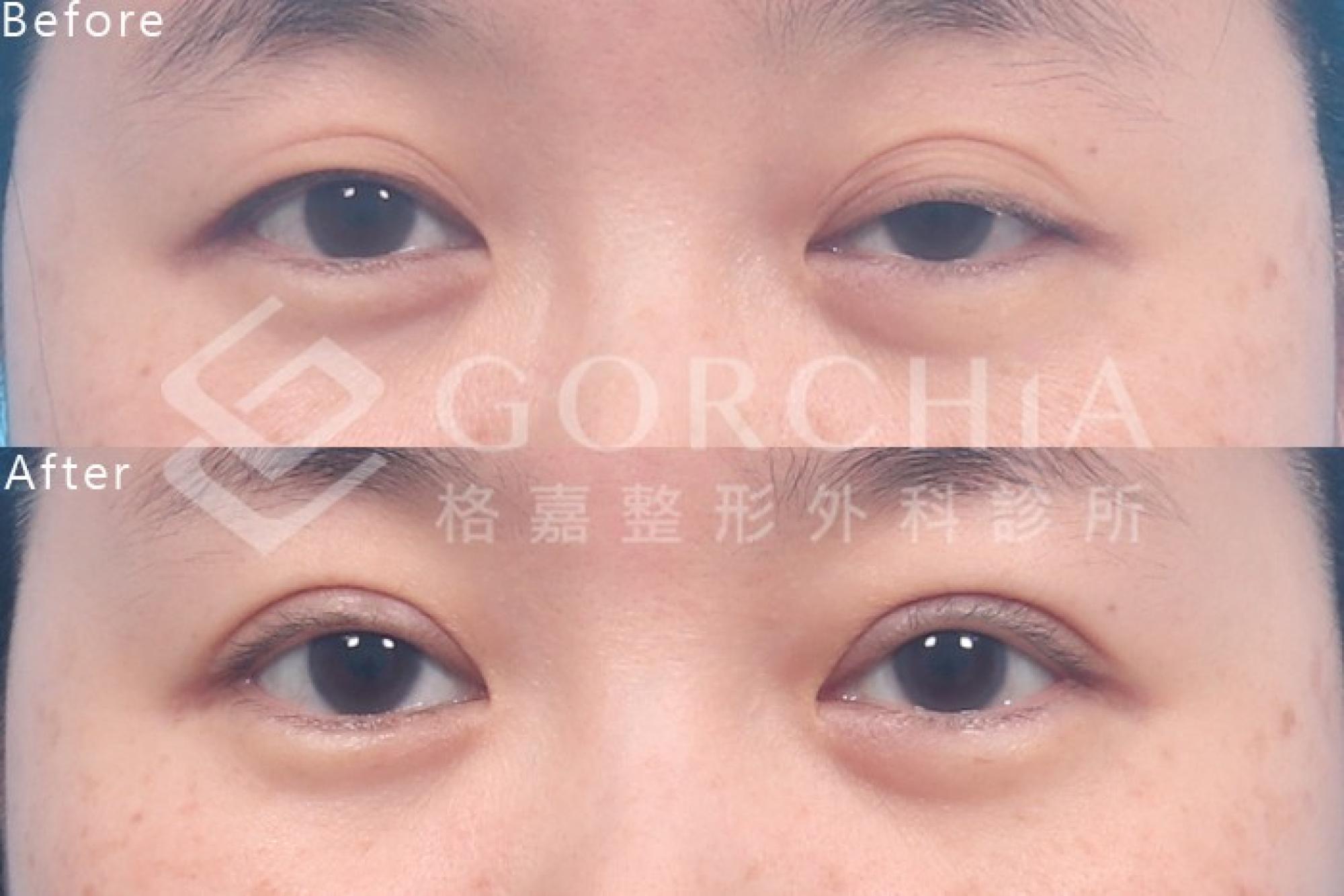 左右眼睜眼力量差異示意(版型測試圖)