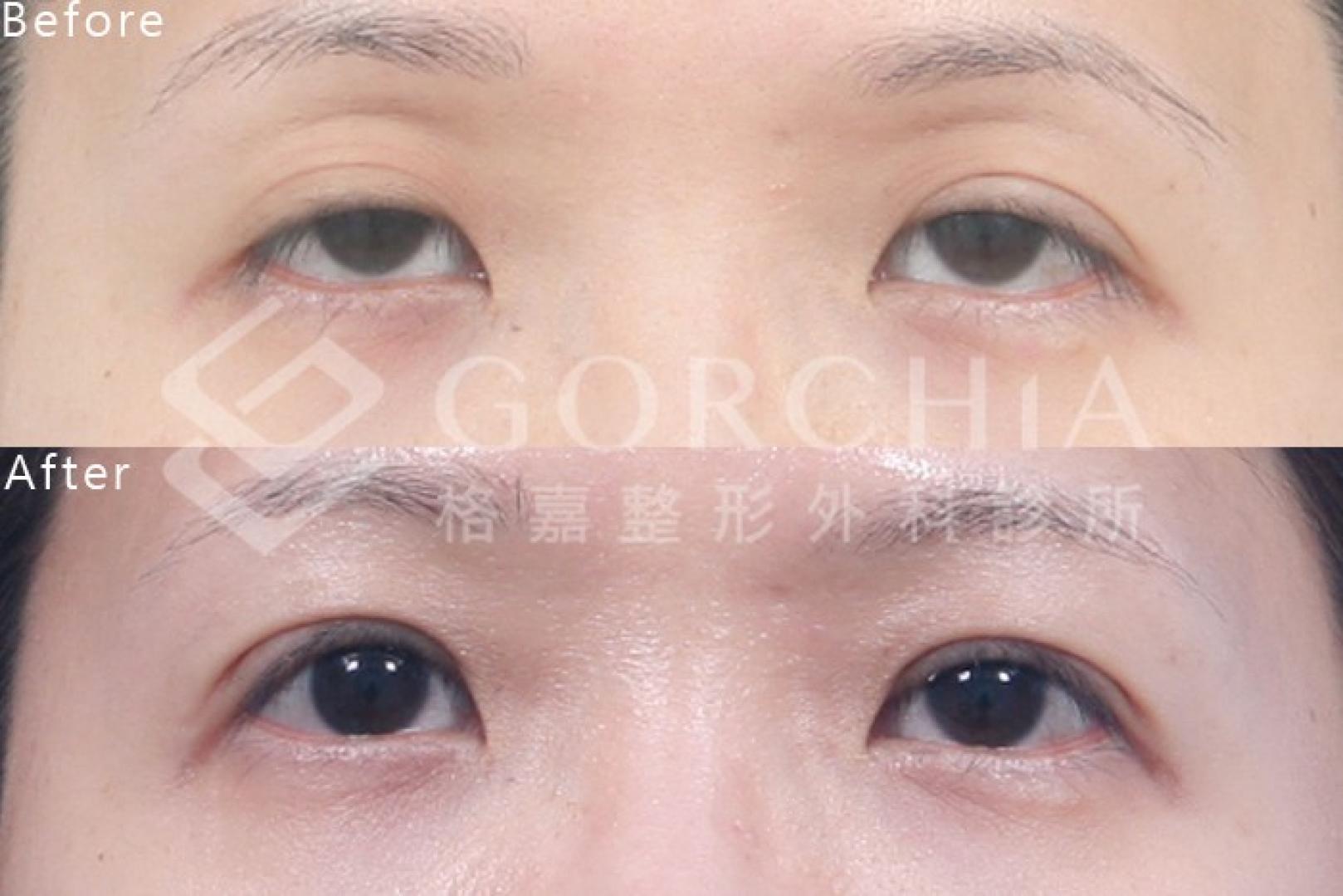 提眼肌調整高度與功能平衡示意(版型測試圖)