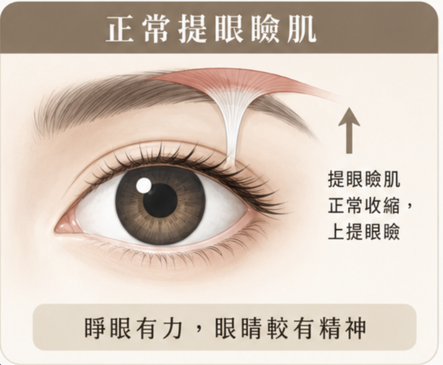 提眼肌功能與眼瞼位置示意(版型測試圖)