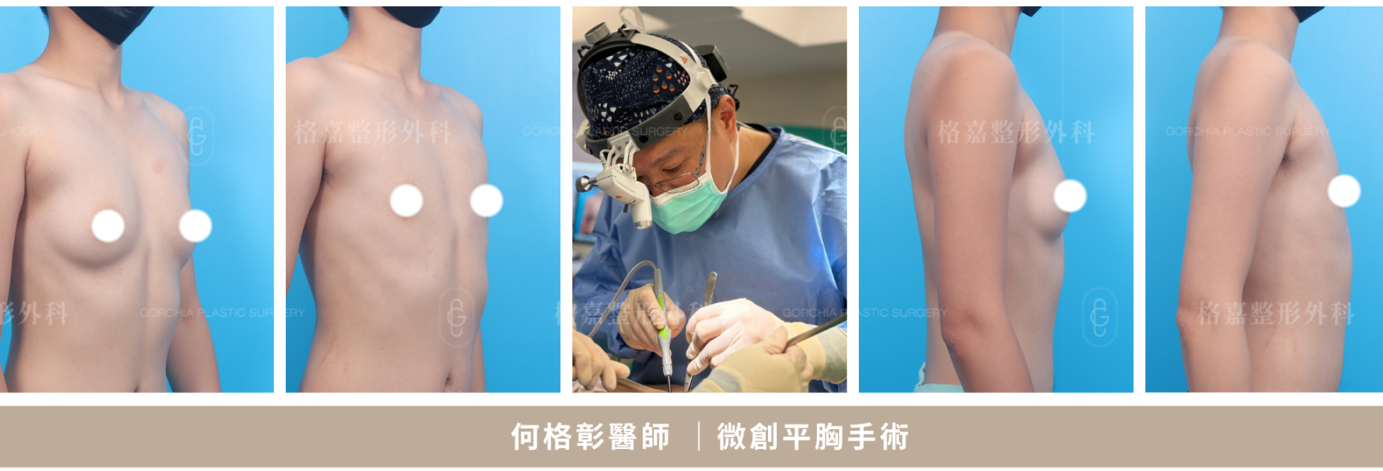 微創平胸乳腺與側胸抽脂處理範圍
