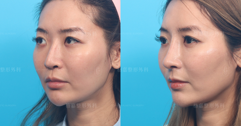 何格彰院長｜結構式隆鼻重修
