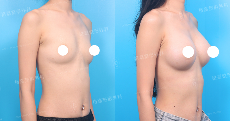 何格彰院長｜女王波隆乳