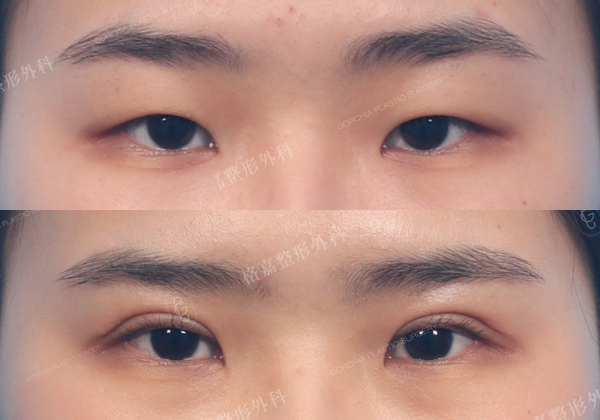 何格彰院長｜割雙眼皮