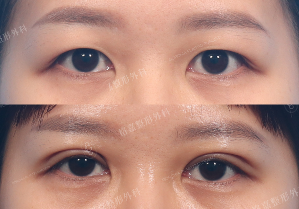 何格彰院長｜割雙眼皮