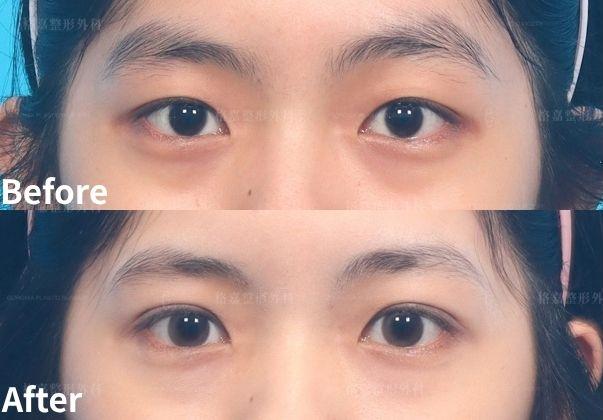 李昱恆醫師｜縫雙眼皮手術