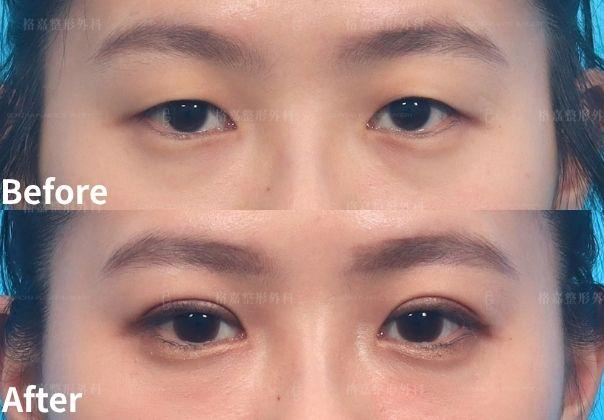 李昱恆醫師｜縫雙眼皮手術