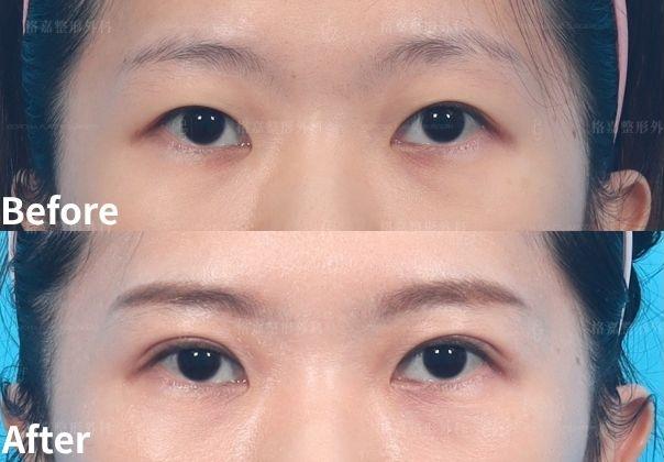 何格彰院長｜縫雙眼皮手術