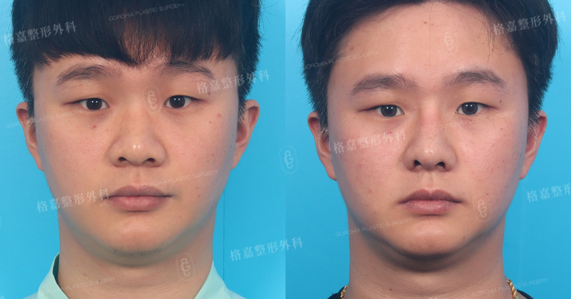 何格彰院長｜結構式隆鼻