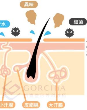 旋轉刀狐臭手術