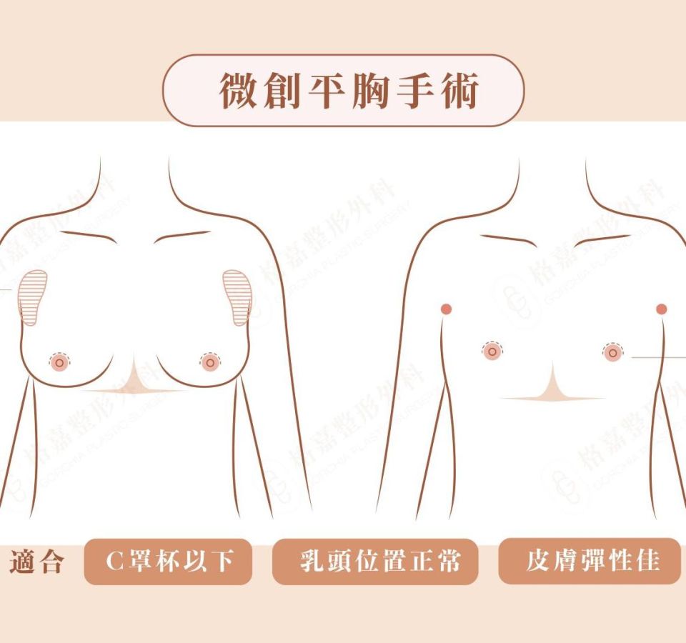 微創平胸手術