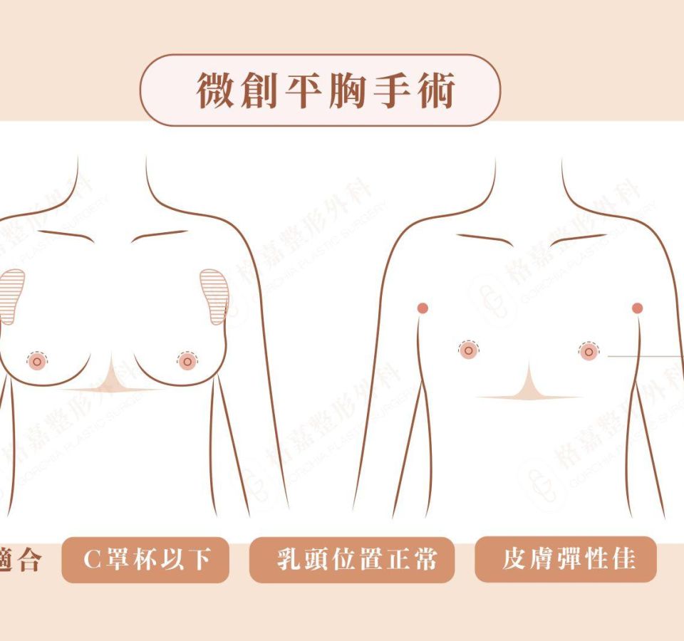 男性女乳症手術