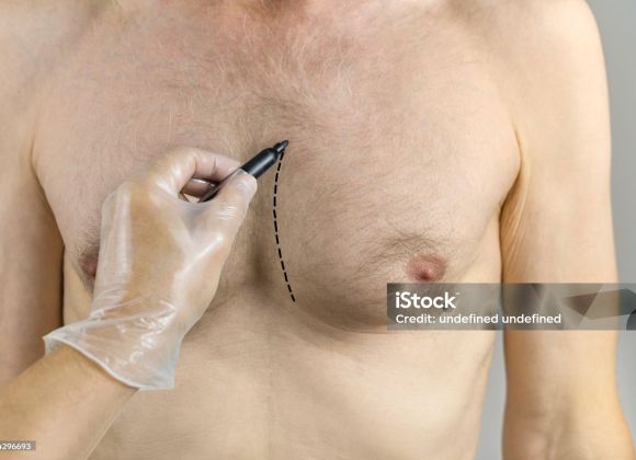 男性女乳症手術