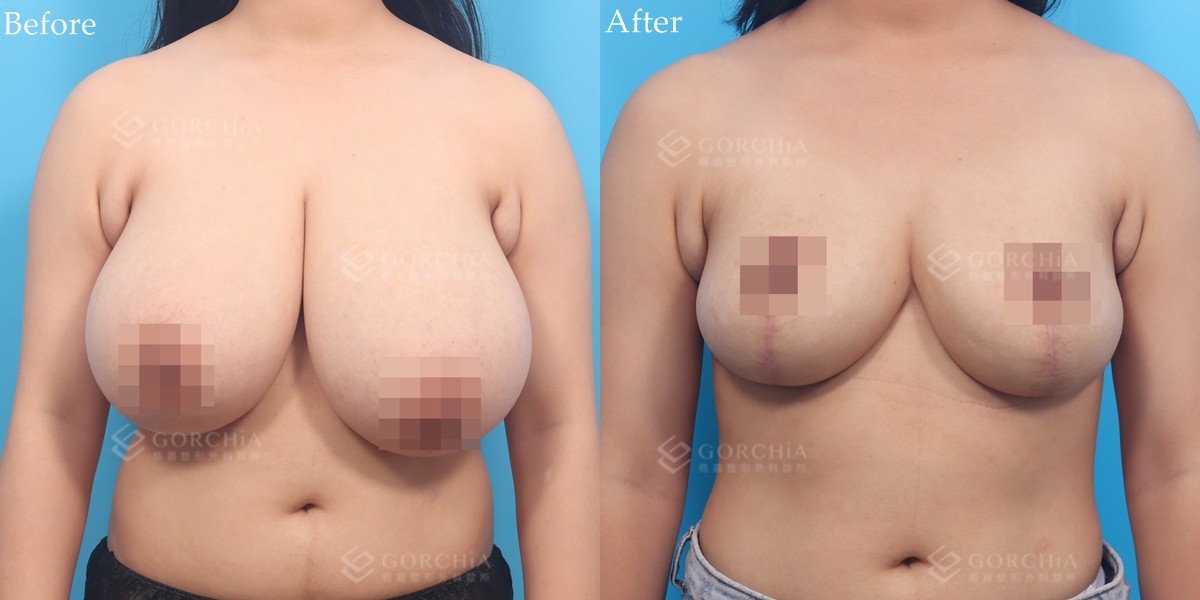 縮乳手術-3