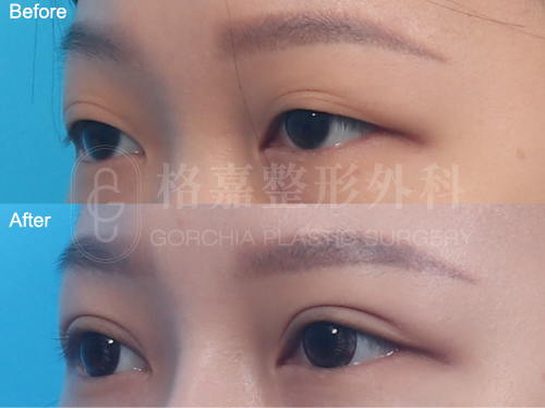 縫雙眼皮113002