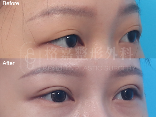縫雙眼皮113003