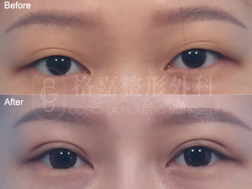 縫雙眼皮113001
