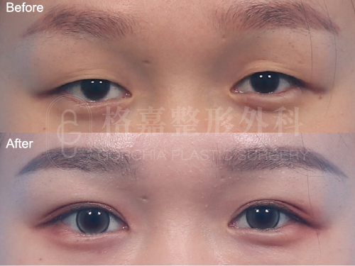 縫雙眼皮+右眼取脂