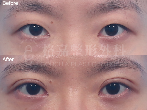 縫雙眼皮120101