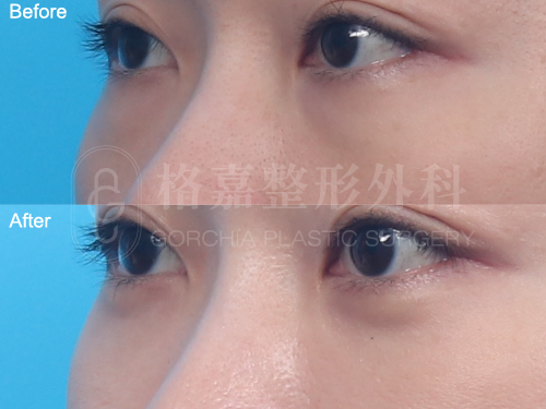 眼袋內開120105