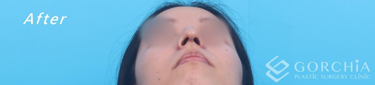 縮鼻翼/鼻孔手術-1