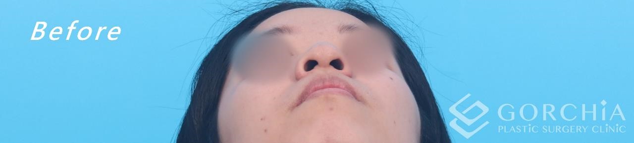 縮鼻翼/鼻孔手術-4