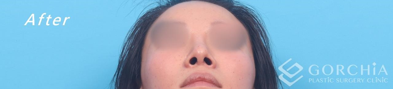 縮鼻翼/鼻孔手術-5